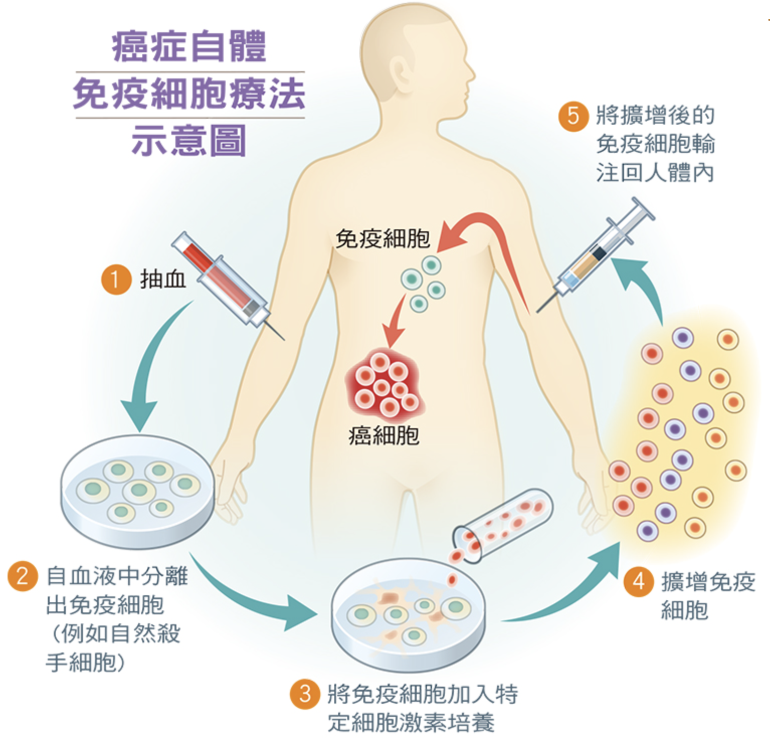 癌症自體免疫細胞療法示意圖