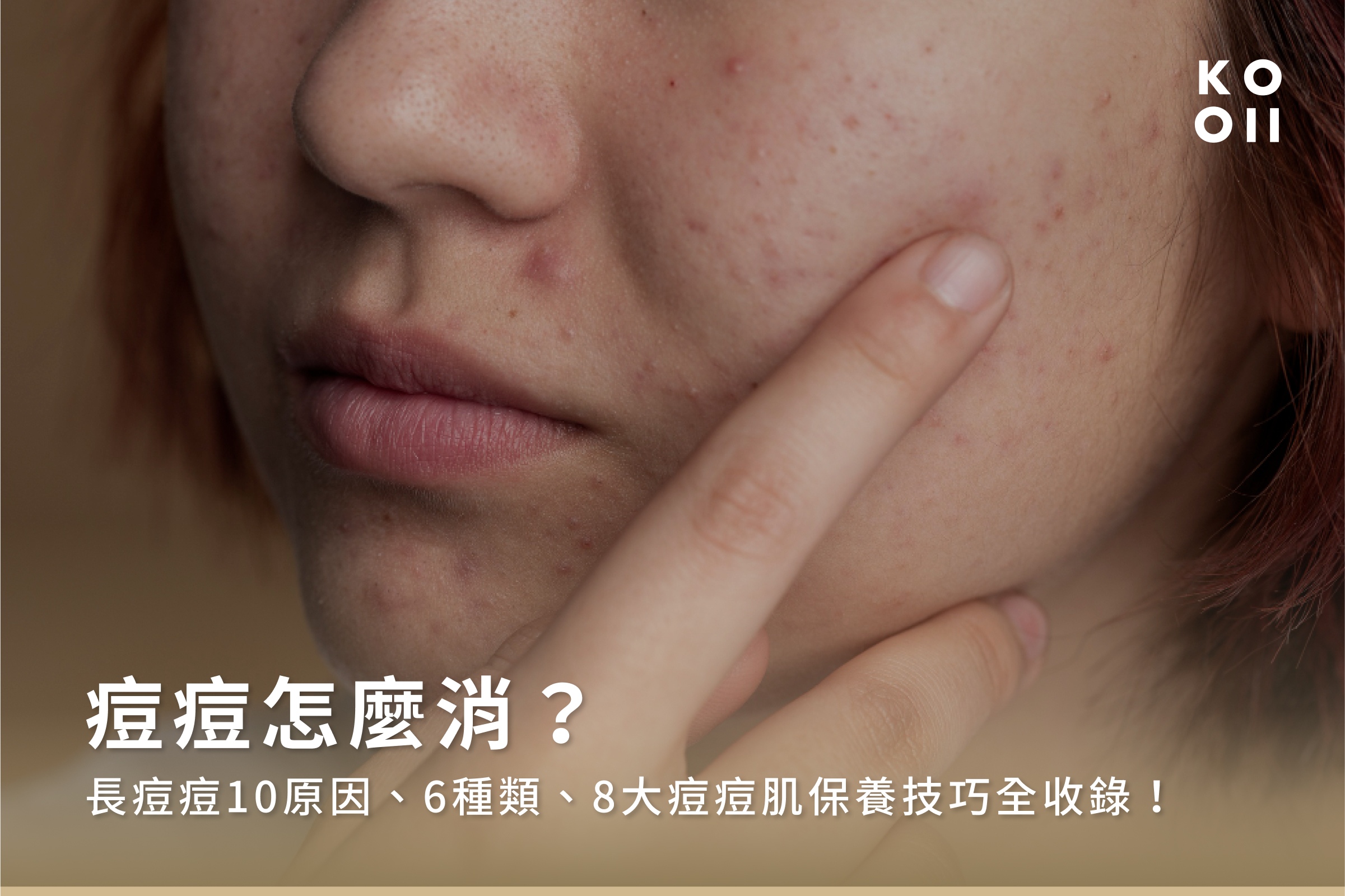 痘痘怎麼消?長痘痘10原因、6種類、8大痘痘肌保養技巧全收錄!
