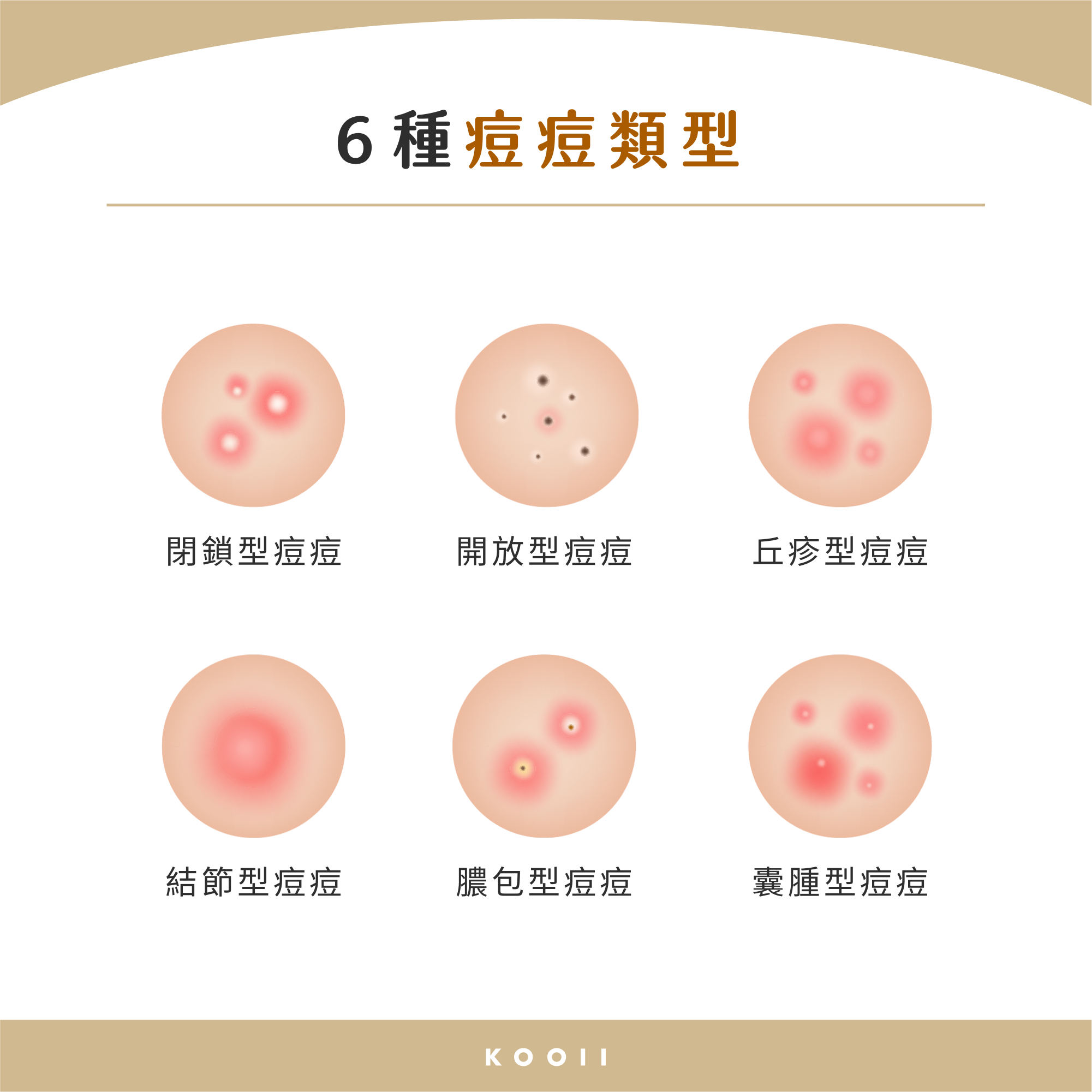 6 種痘痘類型