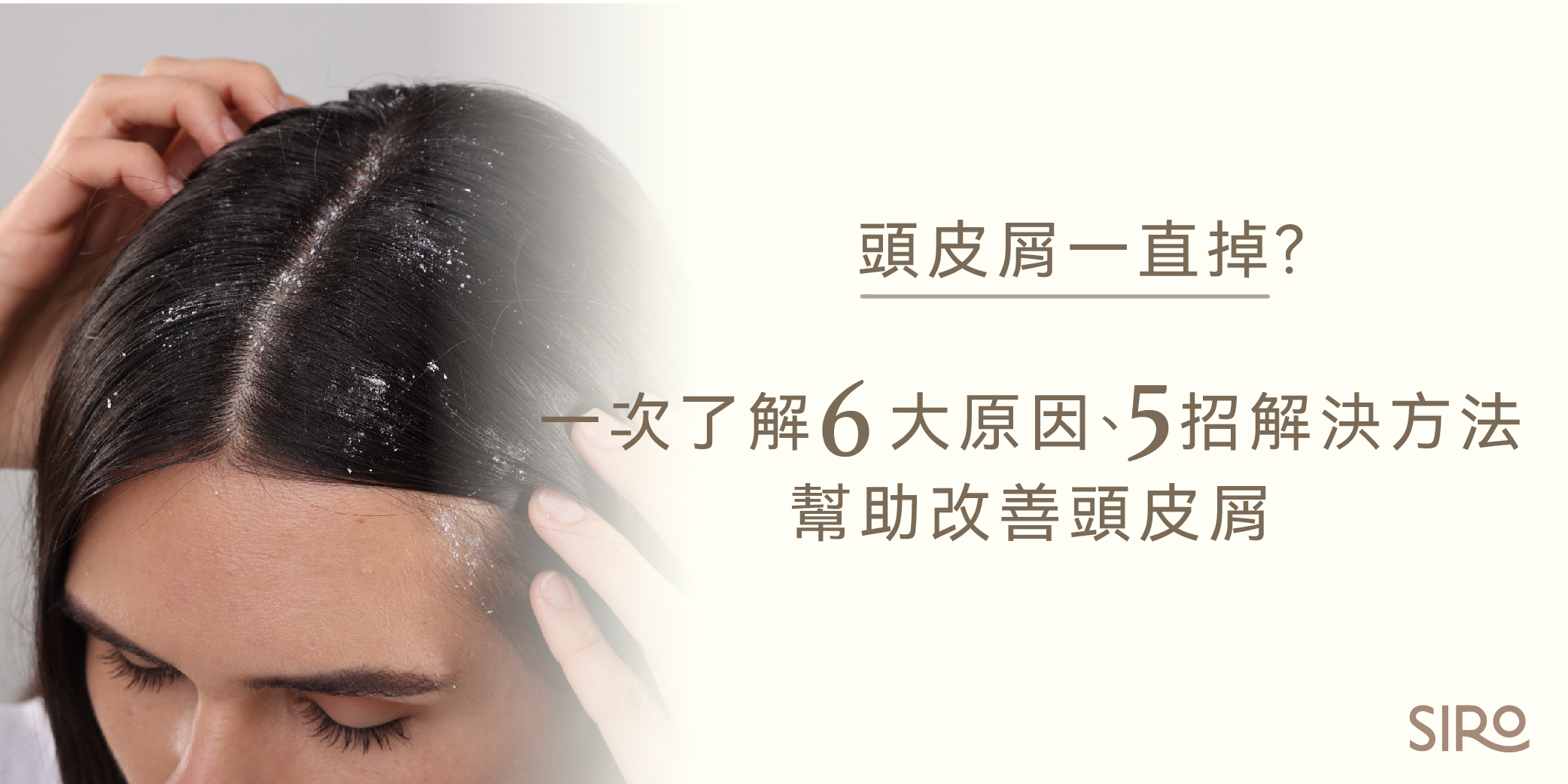 頭皮屑一直掉？一次了解6大原因、5招解決方法，幫助改善頭皮屑