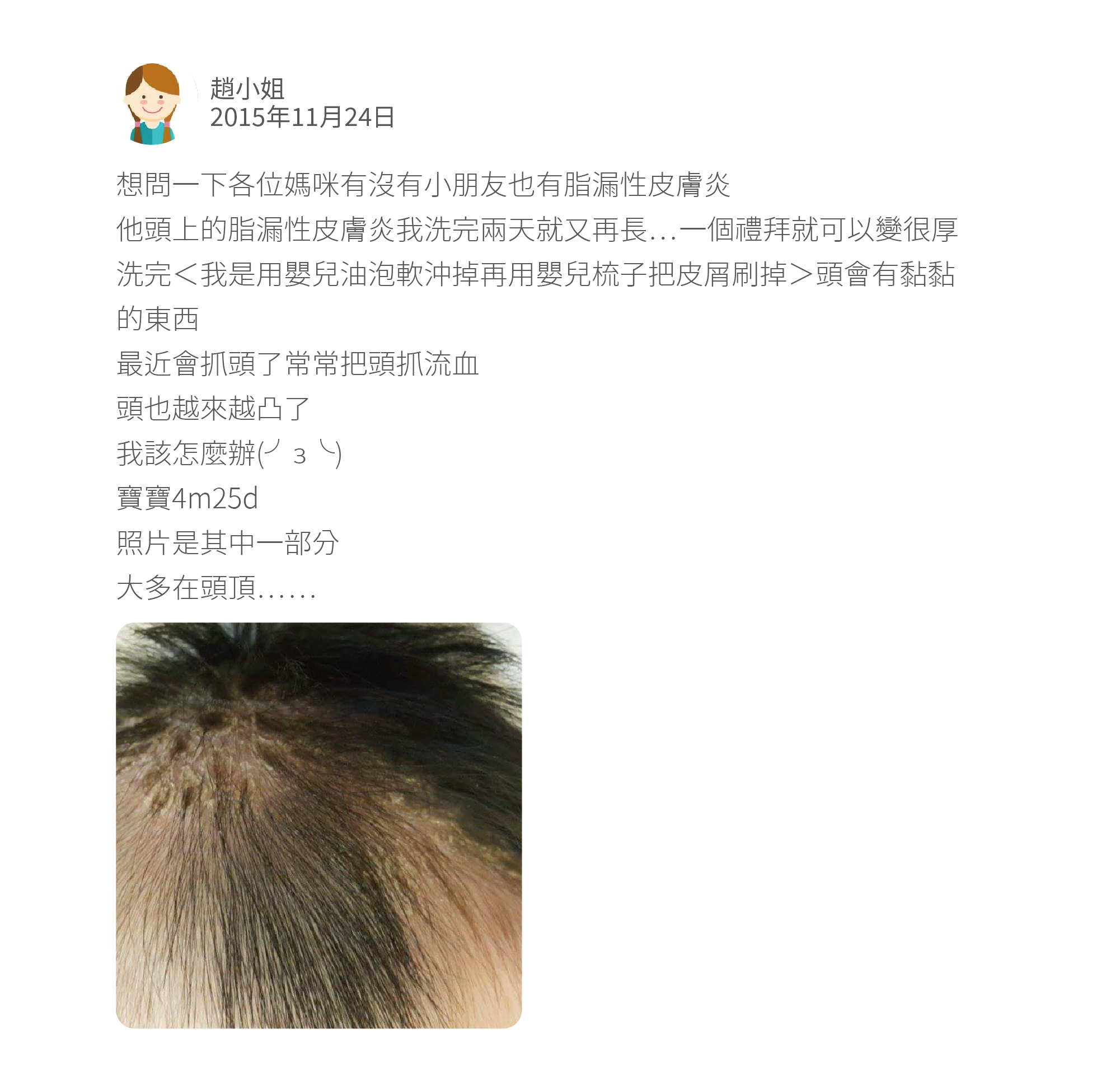 想問一下各位媽咪有沒有小朋友也有脂漏性皮膚炎 他頭上的脂漏性皮膚炎我洗完兩天就又再長…一個禮拜就可以變很厚 洗完<我是用嬰兒油泡軟沖掉再用嬰兒梳子把皮屑刷掉>頭會有黏黏的東西 最近會抓頭了常常把頭抓流血 頭也越來越凸了 我該怎麼辦(╯з╰) 寶寶4m25d 照片是其中一部分 大多在頭頂……