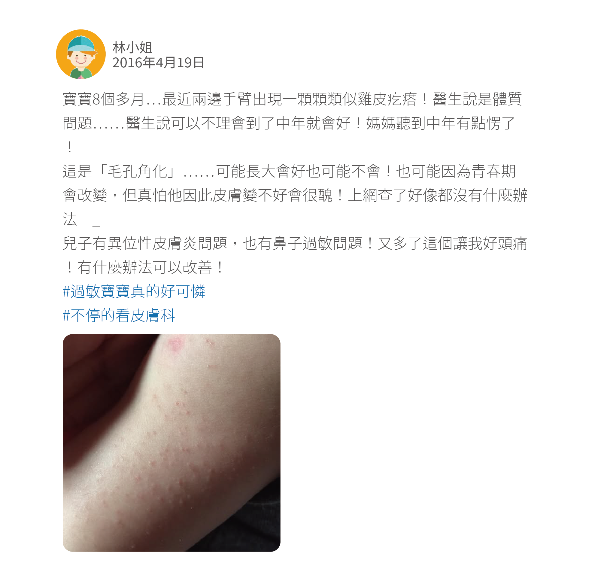 寶寶8個多月⋯最近兩邊手臂出現一顆顆類似雞皮疙瘩！醫生說是體質問題⋯⋯醫生說可以不理會到了中年就會好！媽媽聽到中年有點愣了！ 這是「毛孔角化」⋯⋯可能長大會好也可能不會！也可能因為青春期會改變，但真怕他因此皮膚變不好會很醜！上網查了好像都沒有什麼辦法—_— 兒子有異位性皮膚炎問題，也有鼻子過敏問題！又多了這個讓我好頭痛！有什麼辦法可以改善！ #過敏寶寶真的好可憐 #不停的看皮膚科
