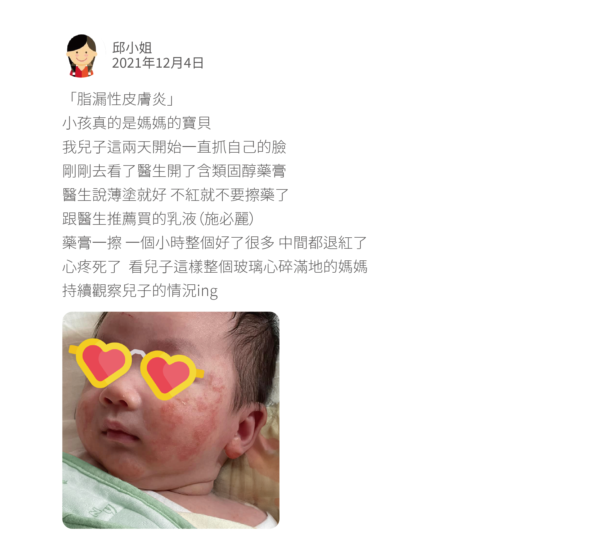 「脂漏性皮膚炎」 小孩真的是媽媽的寶貝 我兒子這兩天開始一直抓自己的臉 剛剛去看了醫生開了含類固醇藥膏 醫生說薄塗就好 不紅就不要擦藥了 跟醫生推薦買的乳液（施必麗） 藥膏一擦 一個小時整個好了很多 中間都退紅了 心疼死了  看兒子這樣整個玻璃心碎滿地的媽媽 持續觀察兒子的情況ing