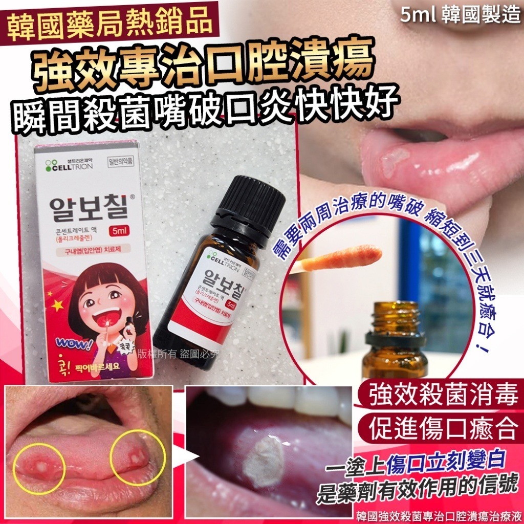 韓國強效殺菌專治口腔潰瘍治療液