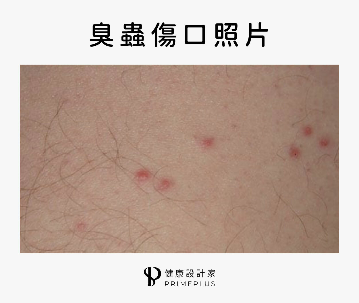 臭蟲咬傷傷口照片