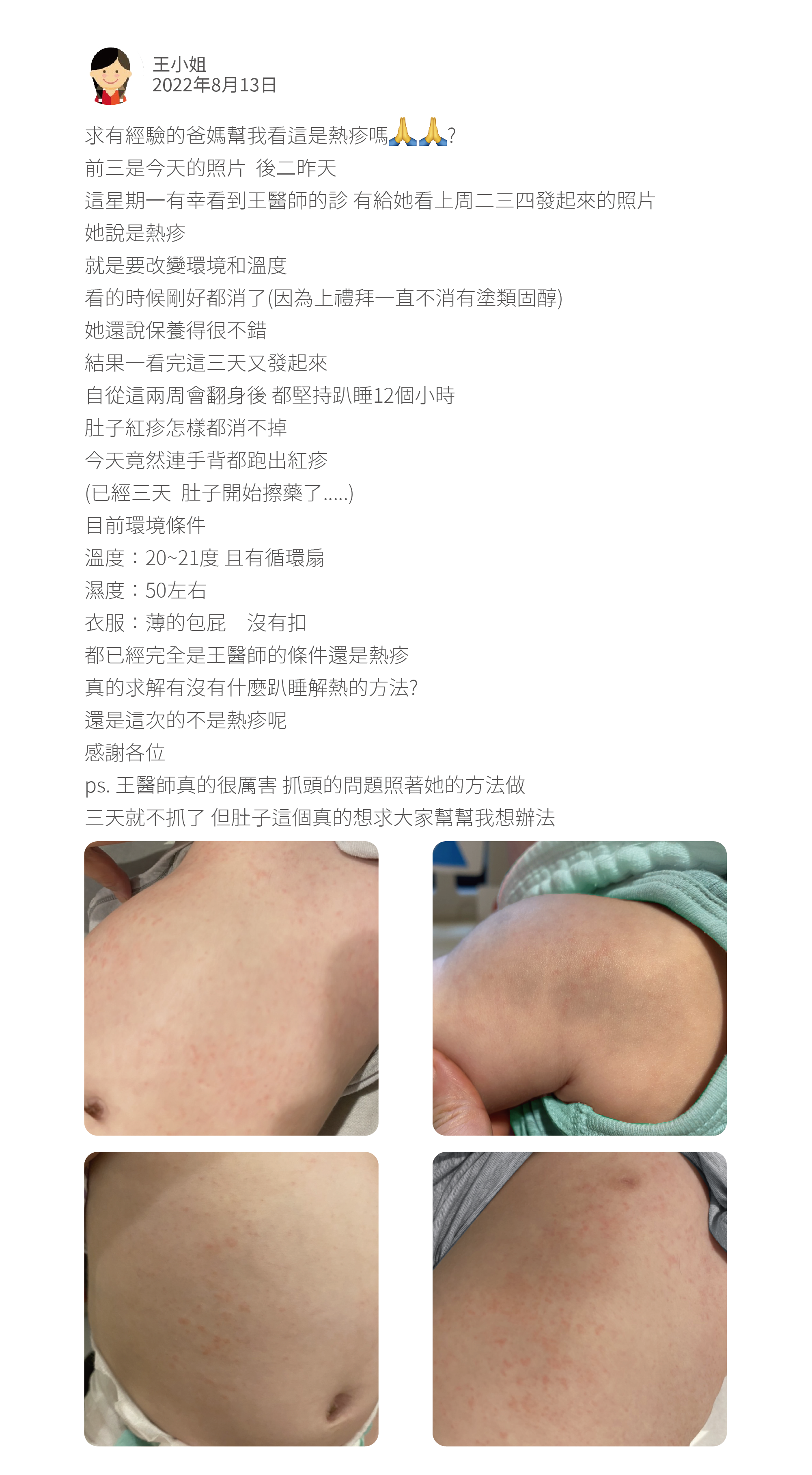 求有經驗的爸媽幫我看這是熱疹嗎 ? 前三是今天的照片  後二昨天 這星期一有幸看到王醫師的診 有給她看上周二三四發起來的照片 她說是熱疹   就是要改變環境和溫度 看的時候剛好都消了(因為上禮拜一直不消有塗類固醇)  她還說保養得很不錯　　  結果一看完這三天又發起來 自從這兩周會翻身後 都堅持趴睡12個小時　 肚子紅疹怎樣都消不掉 今天竟然連手背都跑出紅疹 (已經三天  肚子開始擦藥了.....) 目前環境條件 溫度：20~21度 且有循環扇 濕度：50左右 衣服：薄的包屁　沒有扣 都已經完全是王醫師的條件還是熱疹 真的求解有沒有什麼趴睡解熱的方法? 還是這次的不是熱疹呢 感謝各位 ps. 王醫師真的很厲害 抓頭的問題照著她的方法做 三天就不抓了 但肚子這個真的想求大家幫幫我想辦法