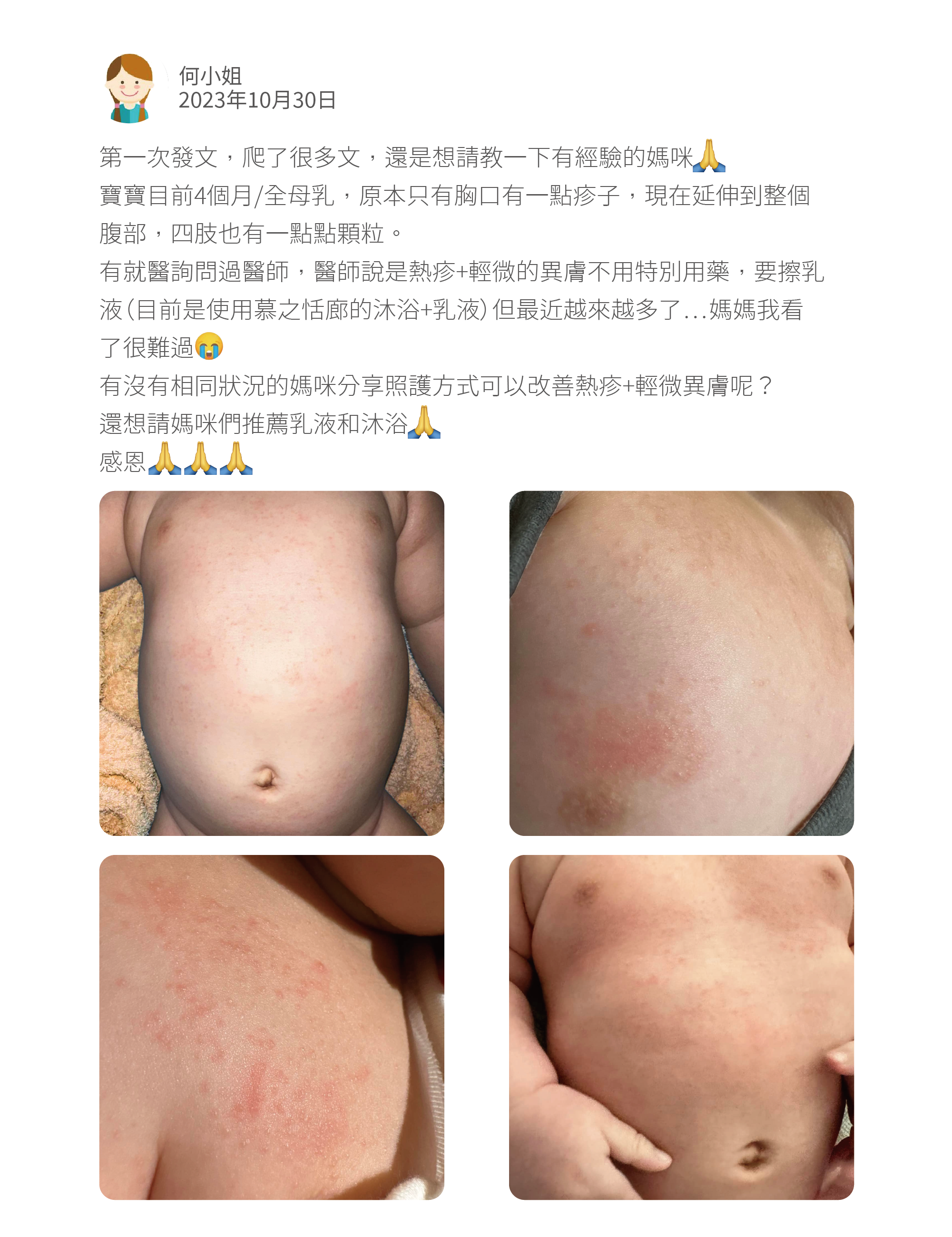 第一次發文，爬了很多文，還是想請教一下有經驗的媽咪 寶寶目前4個月/全母乳，原本只有胸口有一點疹子，現在延伸到整個腹部，四肢也有一點點顆粒。 有就醫詢問過醫師，醫師說是熱疹+輕微的異膚不用特別用藥，要擦乳液（目前是使用慕之恬廊的沐浴+乳液）但最近越來越多了…媽媽我看了很難過 有沒有相同狀況的媽咪分享照護方式可以改善熱疹+輕微異膚呢？ 還想請媽咪們推薦乳液和沐浴 感恩