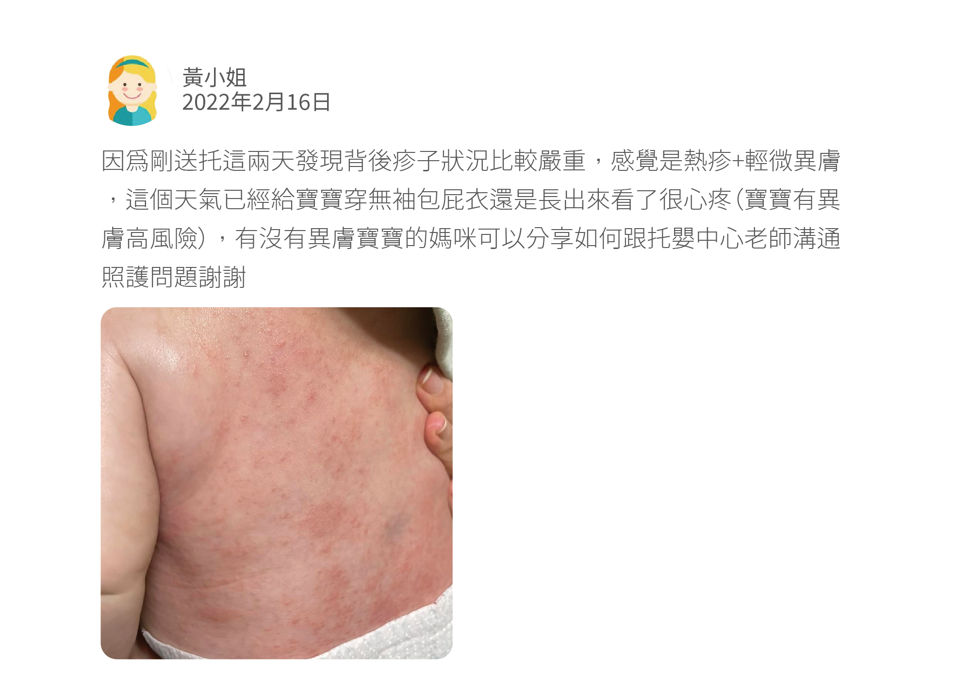 因爲剛送托這兩天發現背後疹子狀況比較嚴重，感覺是熱疹+輕微異膚，這個天氣已經給寶寶穿無袖包屁衣還是長出來看了很心疼（寶寶有異膚高風險），有沒有異膚寶寶的媽咪可以分享如何跟托嬰中心老師溝通照護問題謝謝