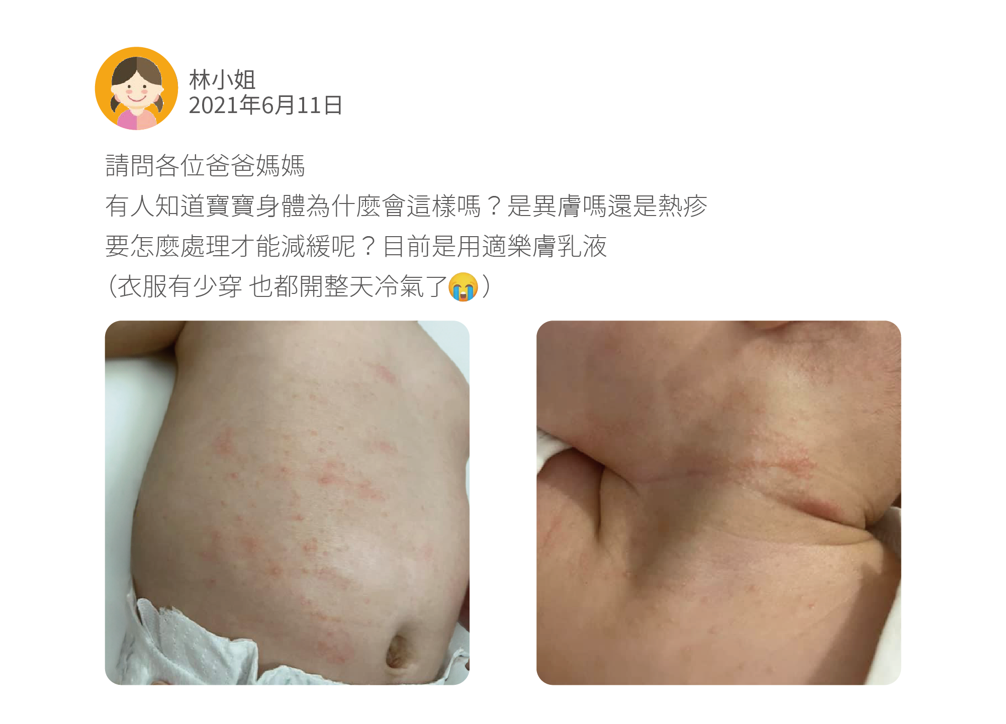 請問各位爸爸媽媽 有人知道寶寶身體為什麼會這樣嗎？是異膚嗎還是熱疹 要怎麼處理才能減緩呢？目前是用適樂膚乳液 （衣服有少穿 也都開整天冷氣了 ）