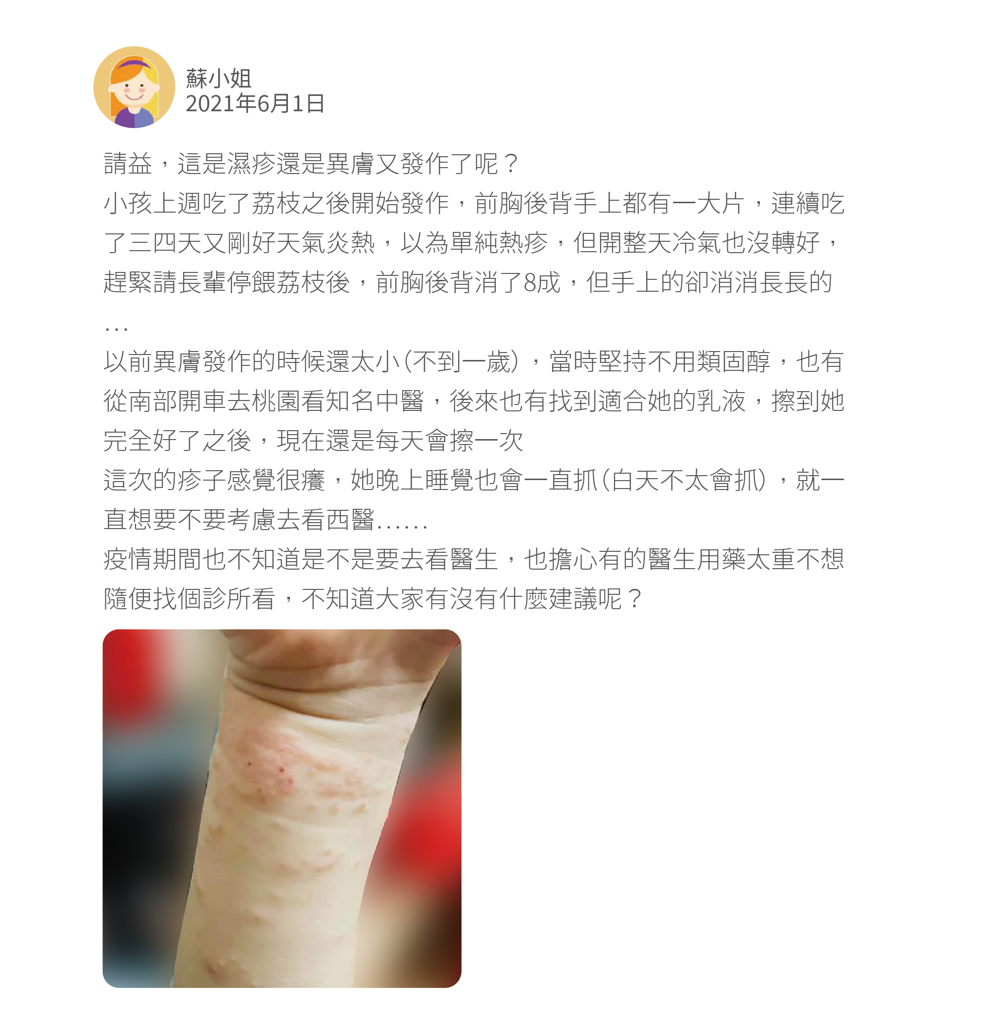 請益，這是濕疹還是異膚又發作了呢？ 小孩上週吃了荔枝之後開始發作，前胸後背手上都有一大片，連續吃了三四天又剛好天氣炎熱，以為單純熱疹，但開整天冷氣也沒轉好，趕緊請長輩停餵荔枝後，前胸後背消了8成，但手上的卻消消長長的⋯ 以前異膚發作的時候還太小（不到一歲），當時堅持不用類固醇，也有從南部開車去桃園看知名中醫，後來也有找到適合她的乳液，擦到她完全好了之後，現在還是每天會擦一次 這次的疹子感覺很癢，她晚上睡覺也會一直抓（白天不太會抓），就一直想要不要考慮去看西醫⋯⋯ 疫情期間也不知道是不是要去看醫生，也擔心有的醫生用藥太重不想隨便找個診所看，不知道大家有沒有什麼建議呢？