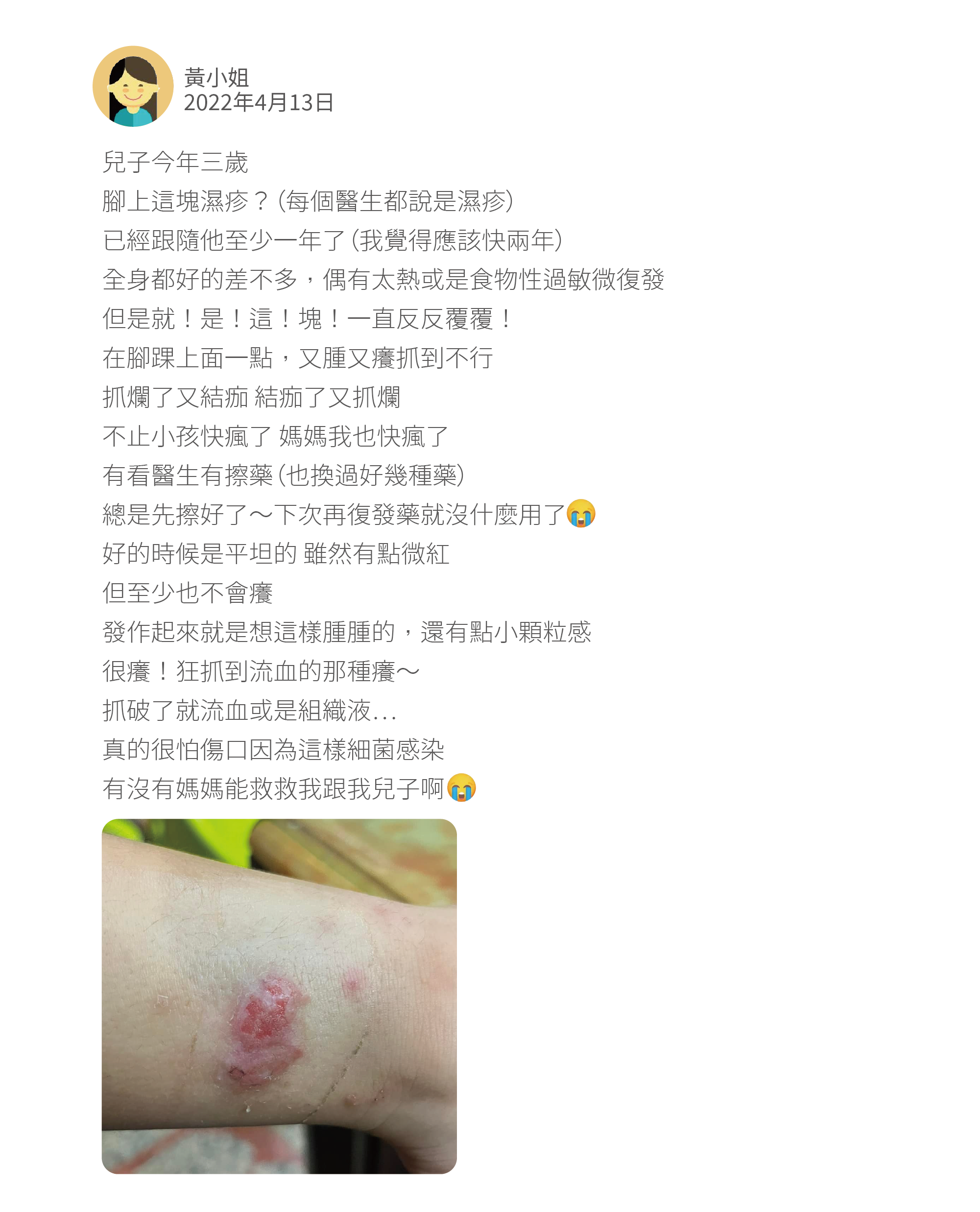 兒子今年三歲 腳上這塊濕疹？（每個醫生都說是濕疹） 已經跟隨他至少一年了（我覺得應該快兩年） 全身都好的差不多，偶有太熱或是食物性過敏微復發 但是就！是！這！塊！一直反反覆覆！ 在腳踝上面一點，又腫又癢抓到不行 抓爛了又結痂 結痂了又抓爛 不止小孩快瘋了 媽媽我也快瘋了 有看醫生有擦藥（也換過好幾種藥） 總是先擦好了～下次再復發藥就沒什麼用了 好的時候是平坦的 雖然有點微紅 但至少也不會癢 發作起來就是想這樣腫腫的，還有點小顆粒感 很癢！狂抓到流血的那種癢～ 抓破了就流血或是組織液⋯ 真的很怕傷口因為這樣細菌感染 有沒有媽媽能救救我跟我兒子啊
