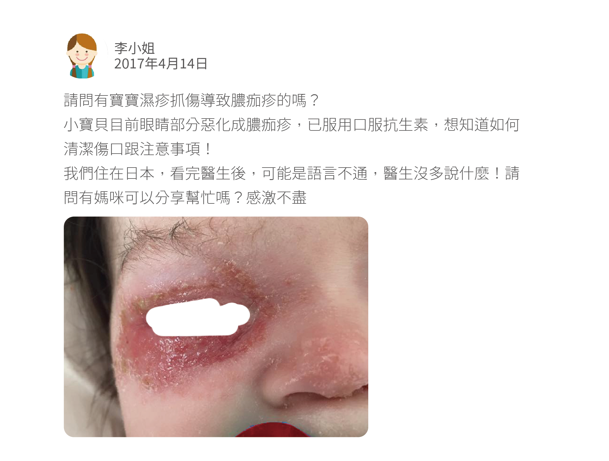 請問有寶寶濕疹抓傷導致膿痂疹的嗎？ 小寶貝目前眼睛部分惡化成膿痂疹，已服用口服抗生素，想知道如何清潔傷口跟注意事項！ 我們住在日本，看完醫生後，可能是語言不通，醫生沒多說什麼！請問有媽咪可以分享幫忙嗎？感激不盡