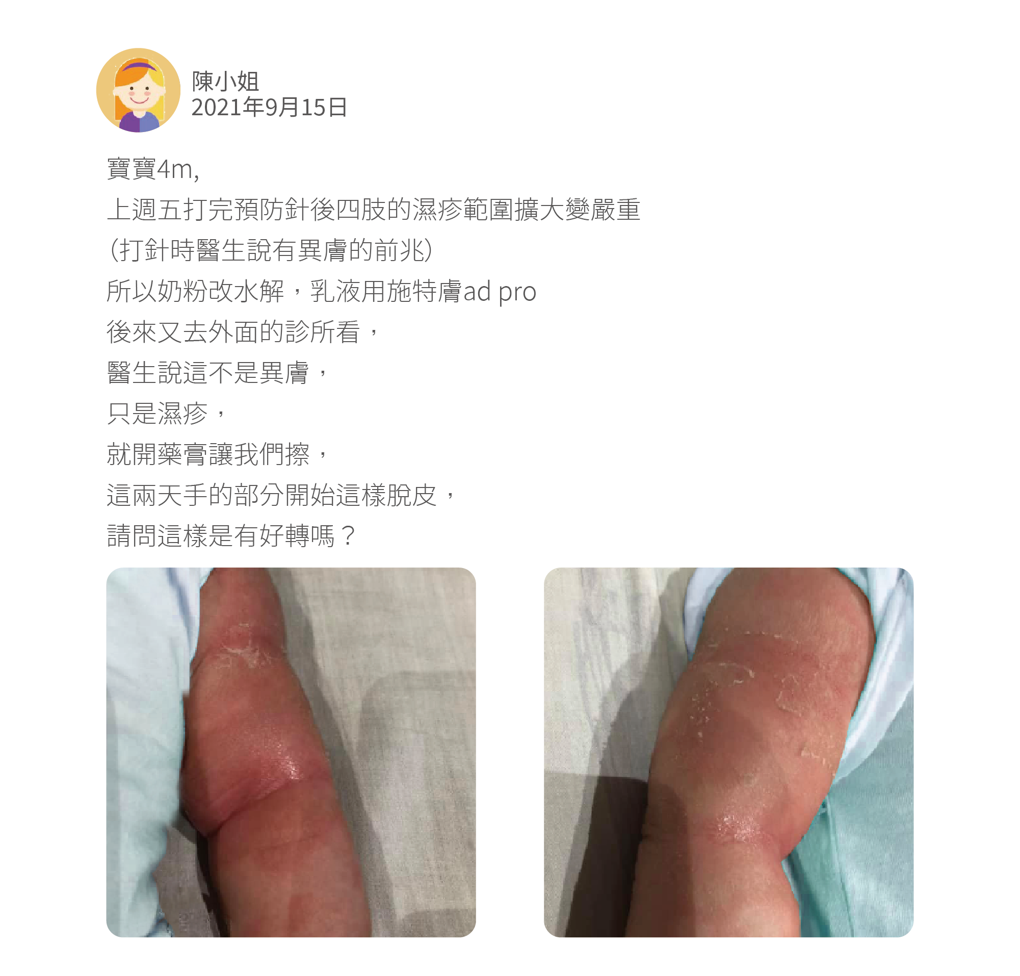 寶寶4m, 上週五打完預防針後四肢的濕疹範圍擴大變嚴重 （打針時醫生說有異膚的前兆） 所以奶粉改水解，乳液用施特膚ad pro 後來又去外面的診所看， 醫生說這不是異膚， 只是濕疹， 就開藥膏讓我們擦， 這兩天手的部分開始這樣脫皮， 請問這樣是有好轉嗎？