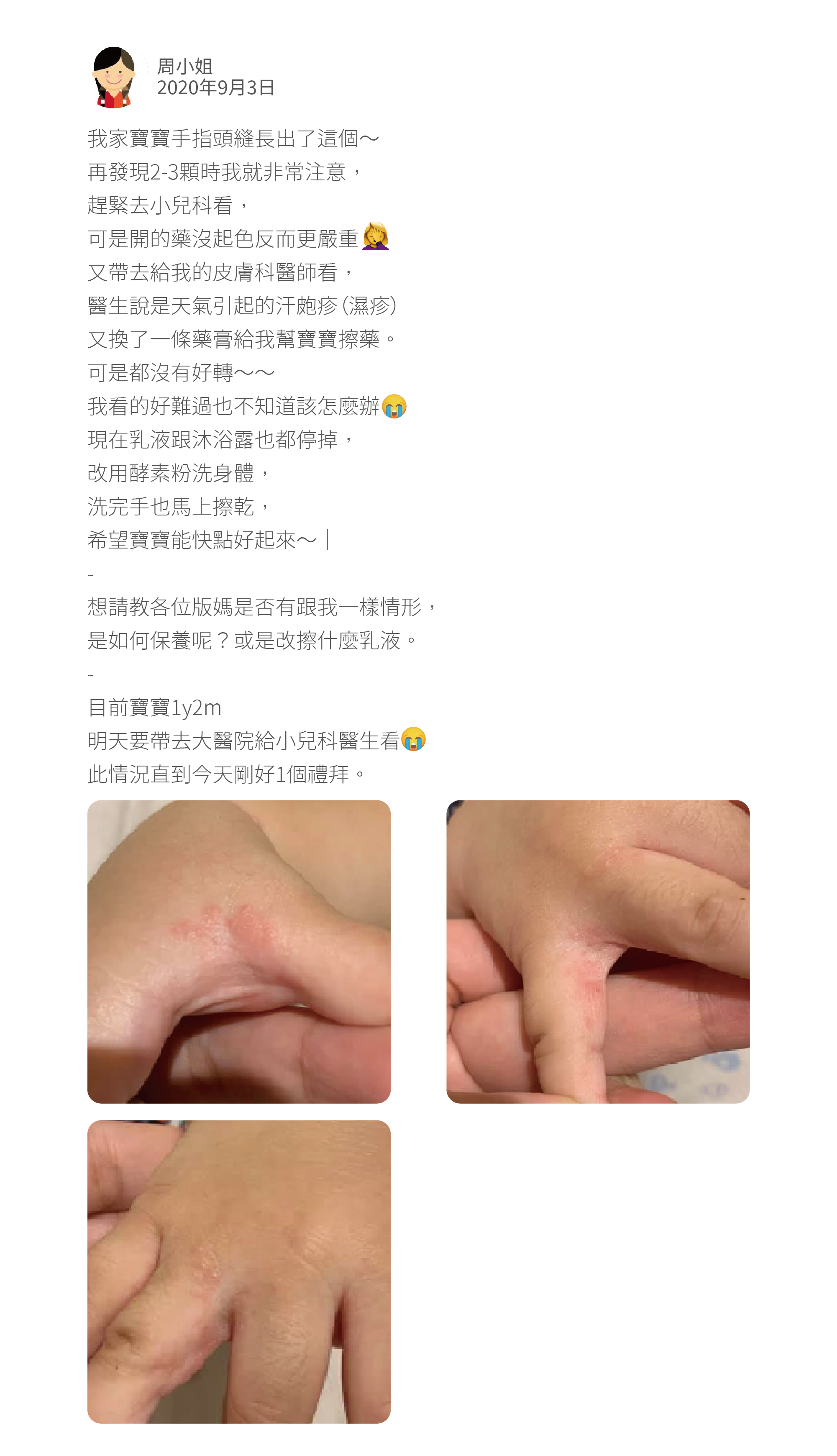 我家寶寶手指頭縫長出了這個～ 再發現2-3顆時我就非常注意， 趕緊去小兒科看， 可是開的藥沒起色反而更嚴重 又帶去給我的皮膚科醫師看， 醫生說是天氣引起的汗皰疹（濕疹） 又換了一條藥膏給我幫寶寶擦藥。 可是都沒有好轉～～ 我看的好難過也不知道該怎麼辦 現在乳液跟沐浴露也都停掉， 改用酵素粉洗身體， 洗完手也馬上擦乾， 希望寶寶能快點好起來～｜ - 想請教各位版媽是否有跟我一樣情形， 是如何保養呢？或是改擦什麼乳液。 - 目前寶寶1y2m 明天要帶去大醫院給小兒科醫生看 此情況直到今天剛好1個禮拜。