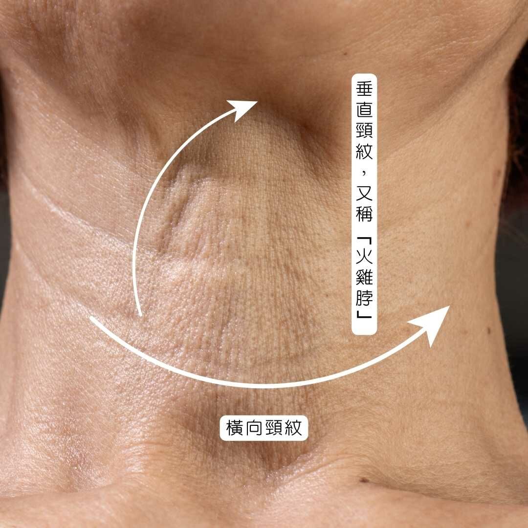 4 種類型頸紋的產生原因及改善方法，頸紋的產生也可能是綜合2種以上的成因，而且一旦產生就不容易消除，因此要提早保養預防。