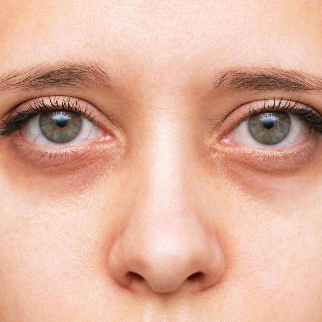黑眼圈有3種類型，想要有效改善就得先了解黑眼圈的類型與成因。