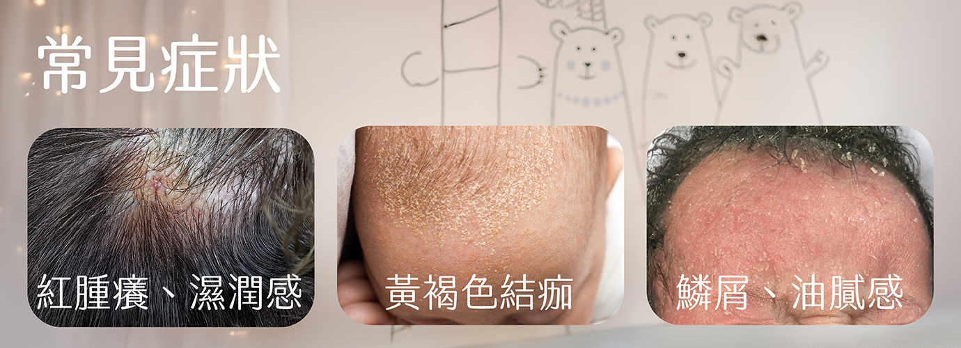囟賽,黃垢,乳痂,脂漏性頭皮