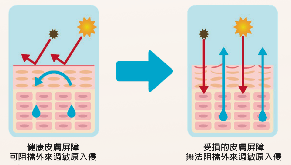 肌膚屏障對異位性皮膚炎的重要性