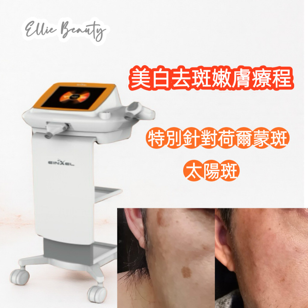 TR21 美白去斑嫩膚療程-單次