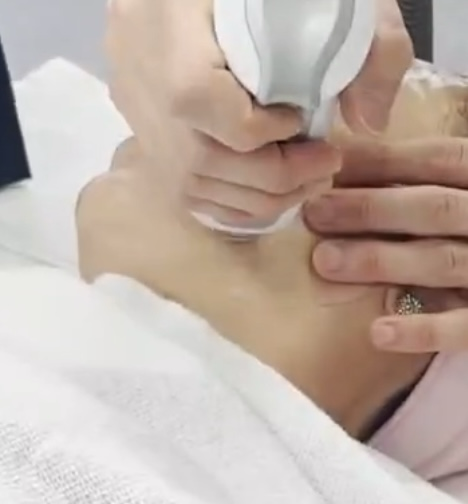 TR25 EINXEL PLUS 頸紋彈彈槍-單次