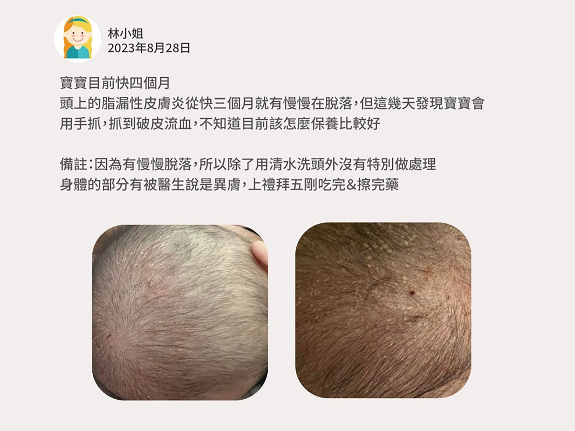 寶寶目前快四個月 頭上的脂漏性皮膚炎從快三個月就有慢慢在脫落,但這幾天發現寶寶會用手抓,抓到破皮流血,不知道目前該怎麼保養比較好