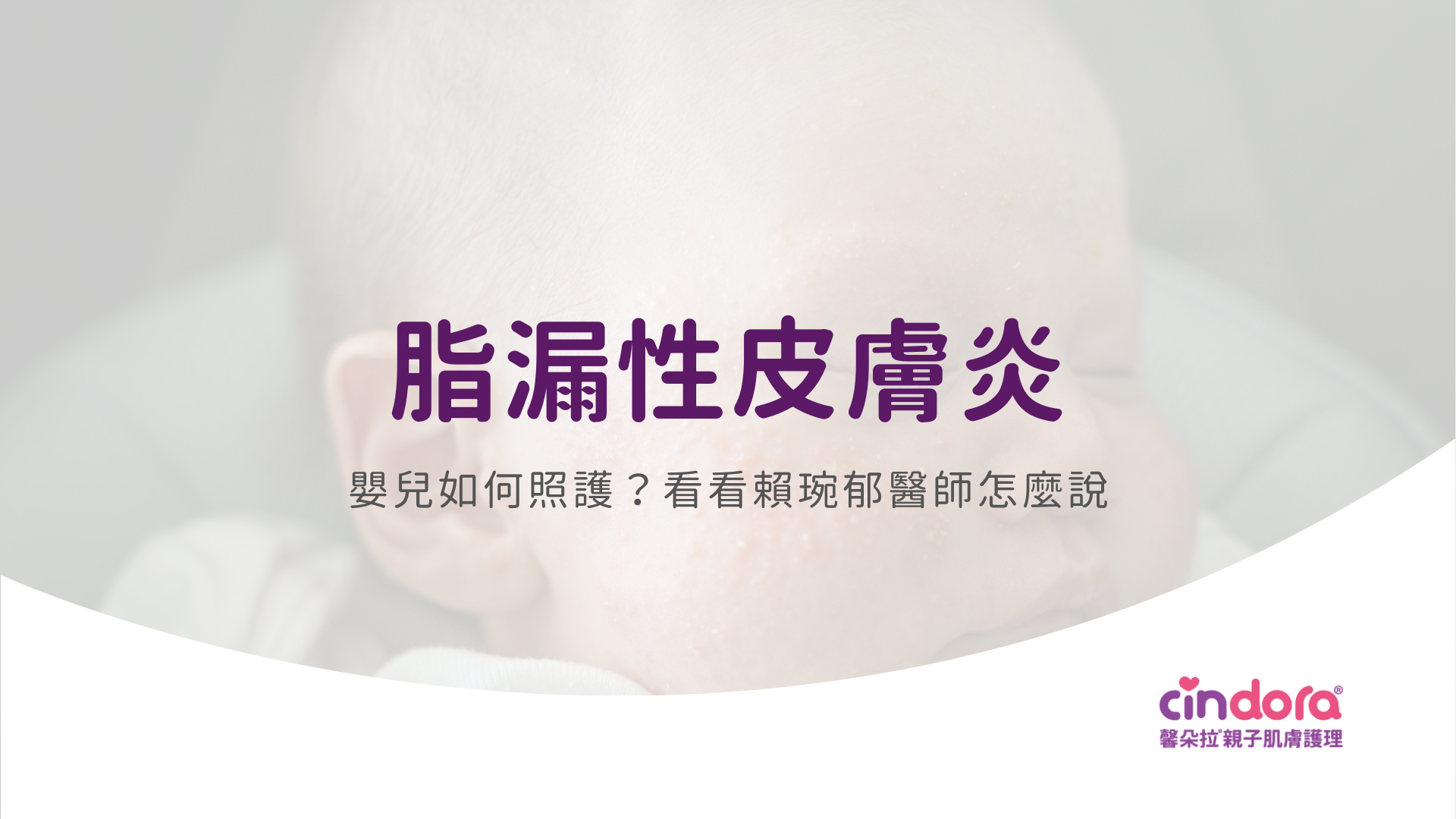 脂漏性皮膚炎
