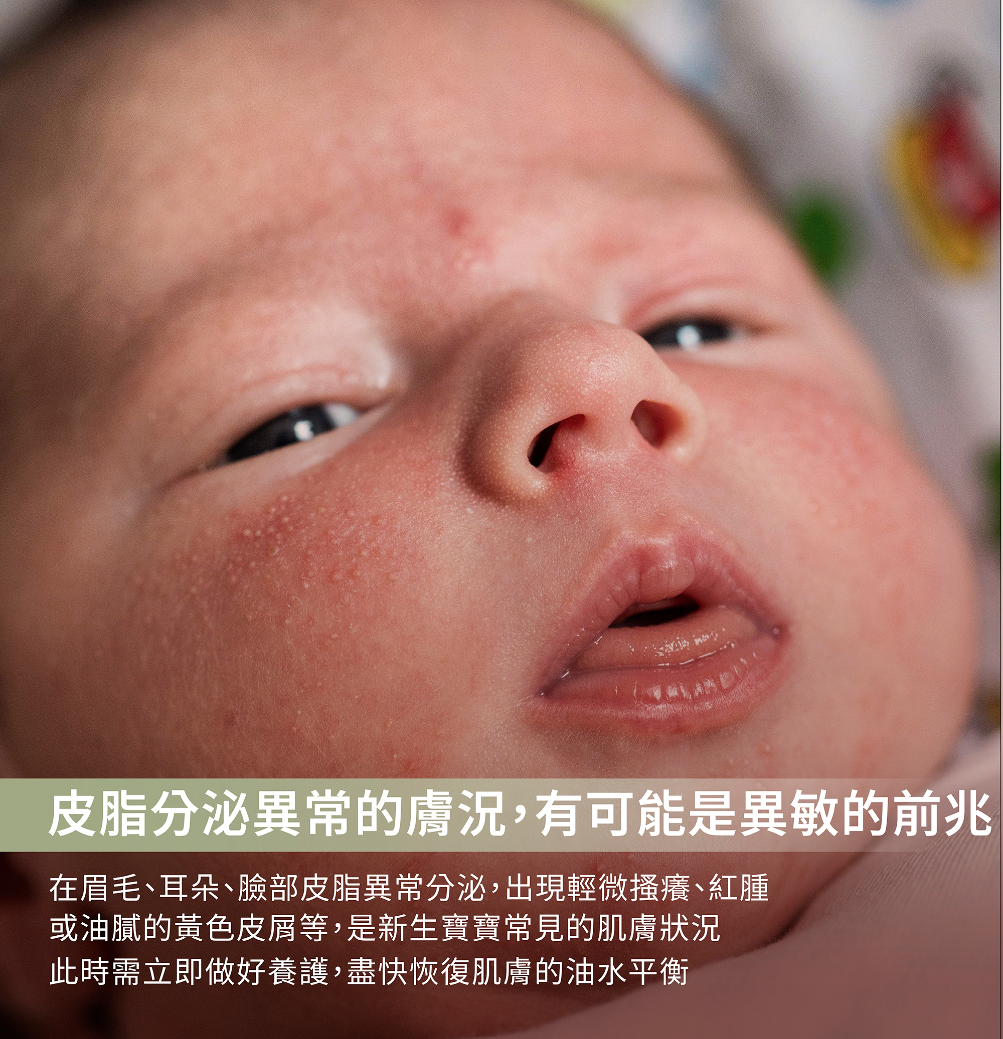 脂漏乳液,蠶豆症可以用,肌膚粗糙,植物配方,過敏乳液,寶寶脂漏保養,乾癢過敏