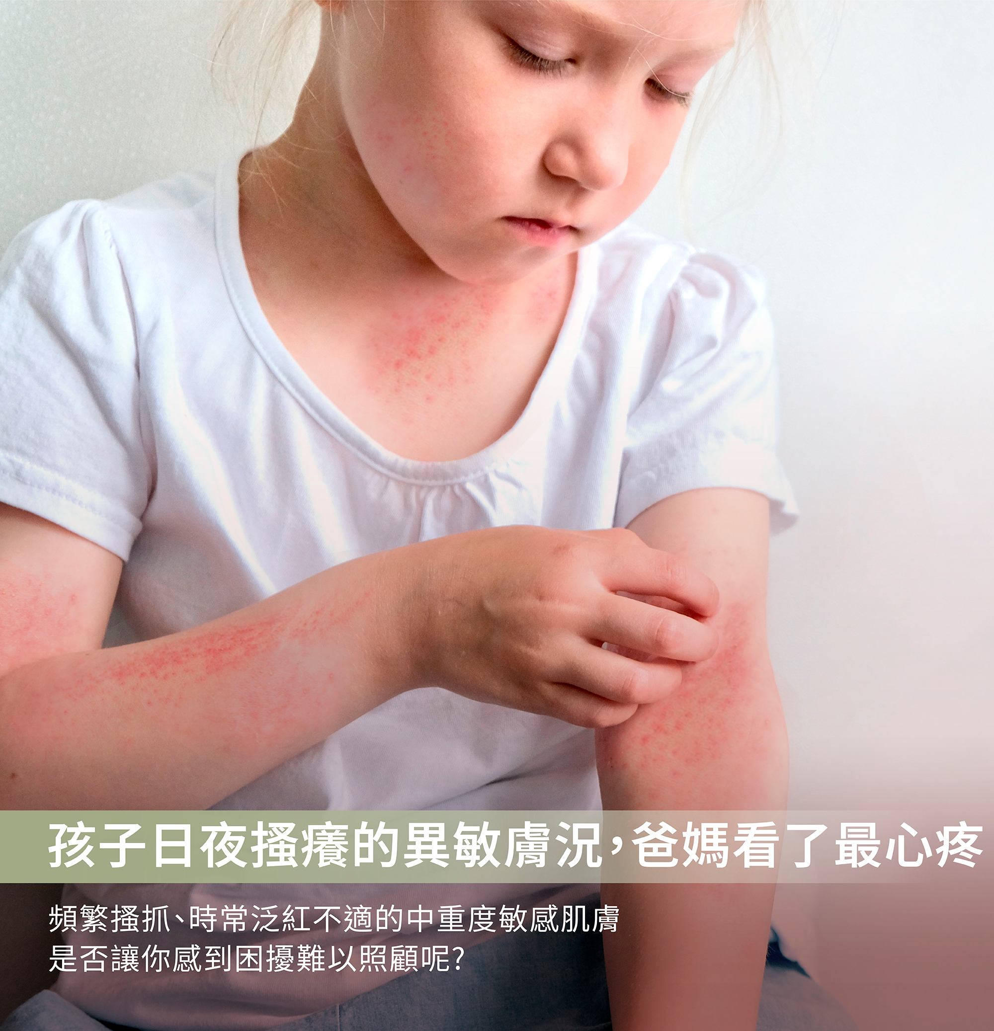 中度異膚,植物配方,中重度過敏,重度皮膚紅癢,乾癢過敏,修護肌膚