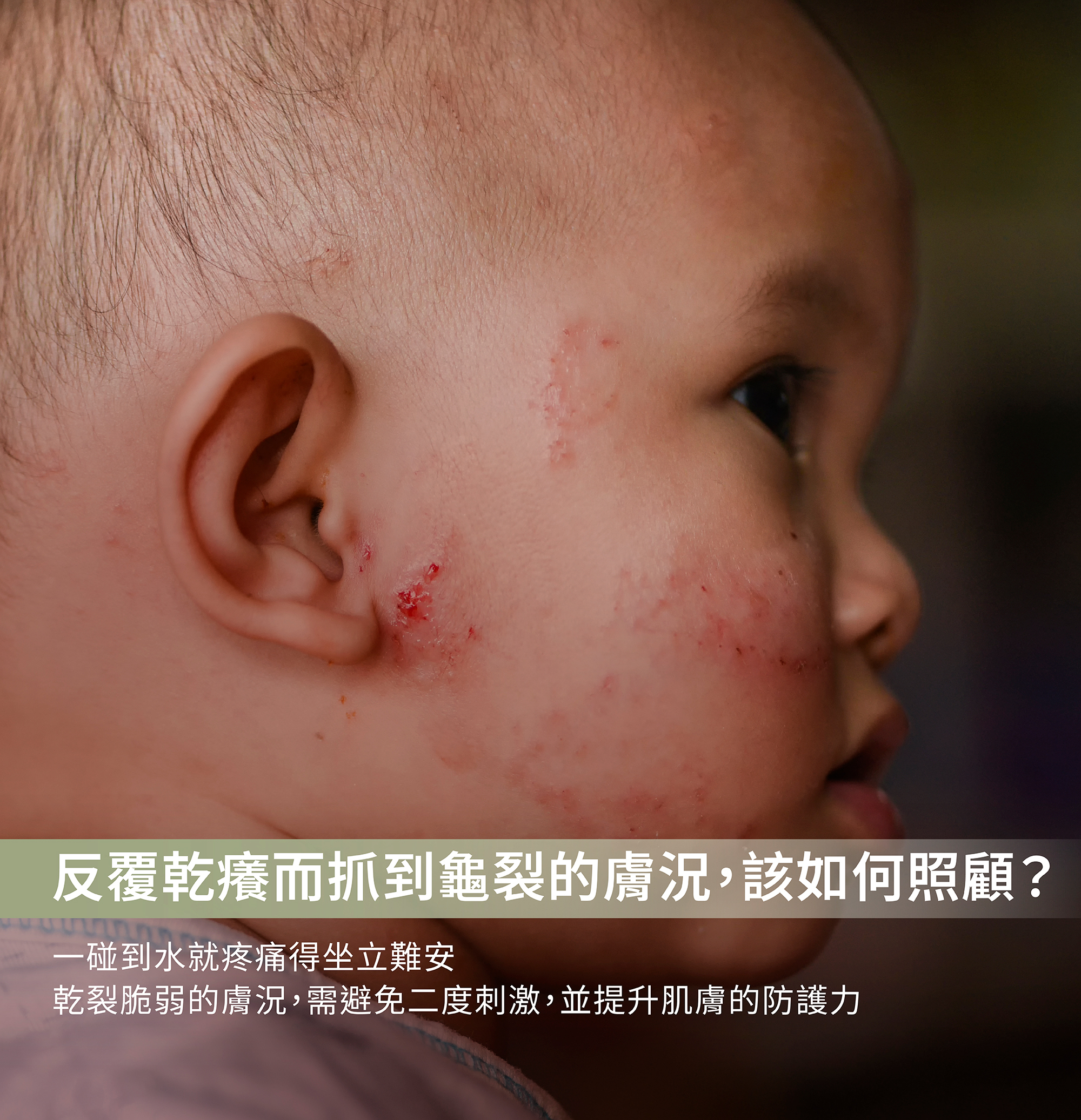 重度皮膚炎,異位性皮膚炎,流血,皮膚有傷口照顧,皮膚受傷照顧,屏障受損保養,擦完藥的保養