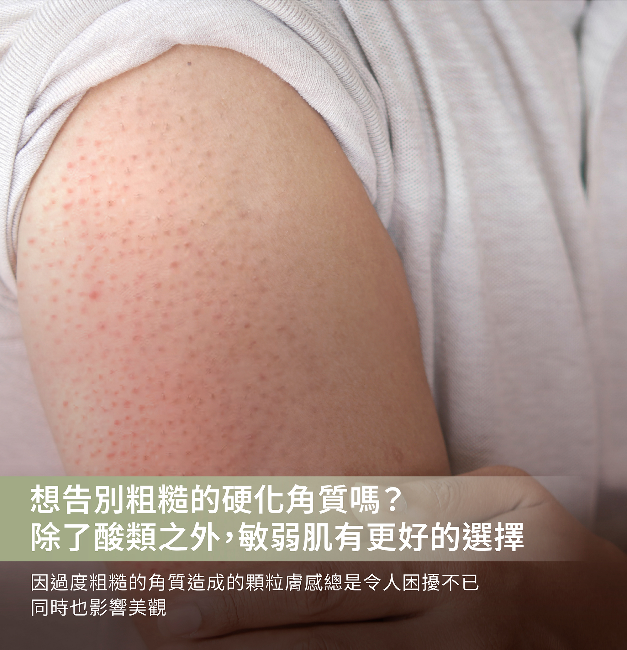 毛囊角化保養,乾癢過敏,A酸換膚好嗎,A醇,去角質,皮膚角化保濕乳霜,粗糙軟化,皮膚柔軟