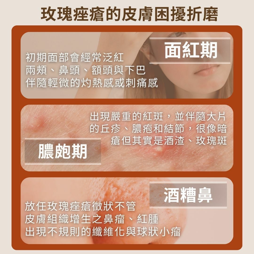 玫瑰痤瘡發作時的徵狀十分折磨煎熬