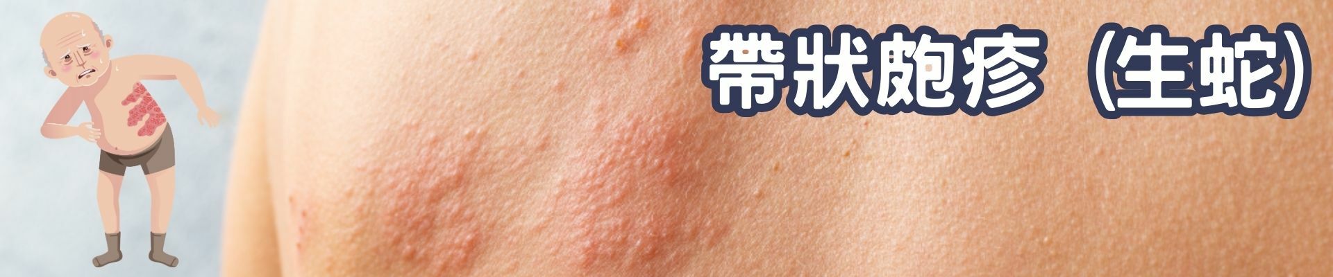 帶狀皰疹（生蛇）常見皮膚症狀圖，單側紅疹與水泡，多見於年長者或免疫力低下者