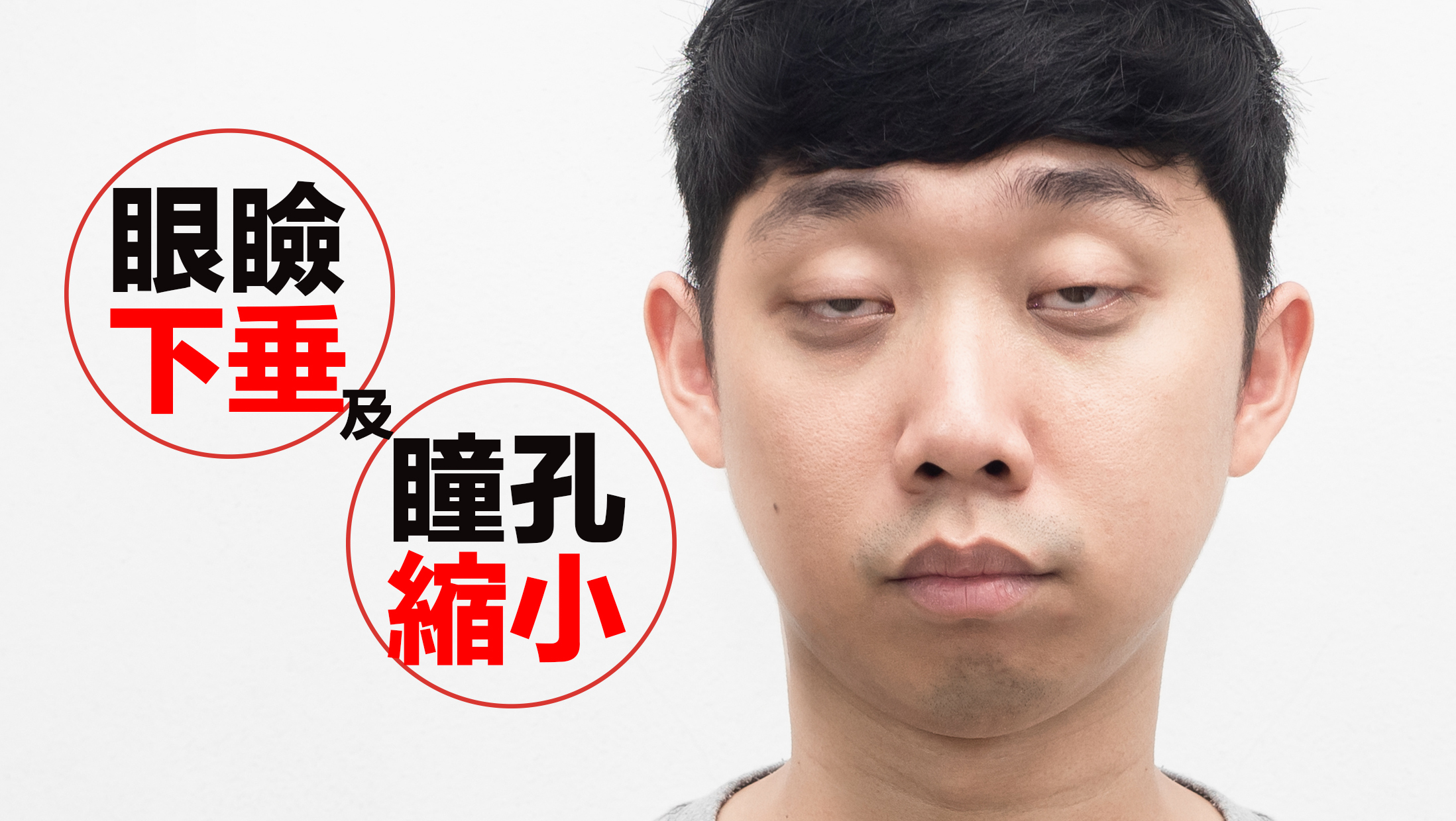 眼瞼下垂及瞳孔縮小：當異細胞生長在肺上葉頂端，壓迫或侵犯鄰近的交感神經時，可能導致霍納氏症候群出現，症狀包括單側眼下垂、瞳孔縮小或眼球內陷。
