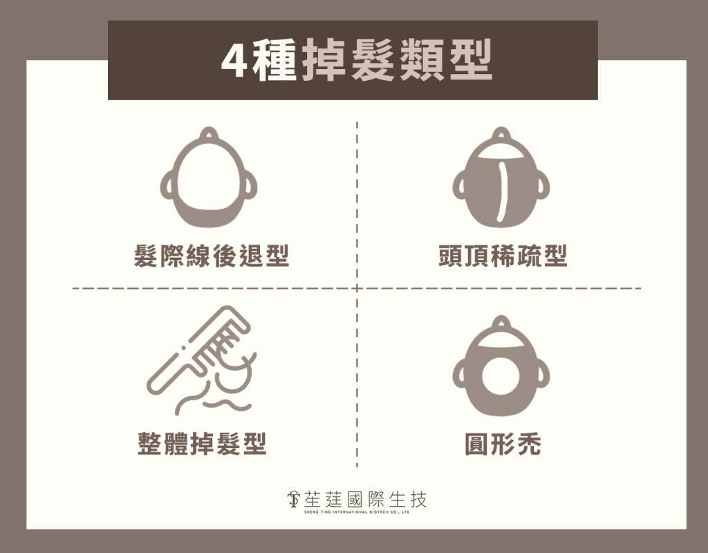 4種掉髮類型
