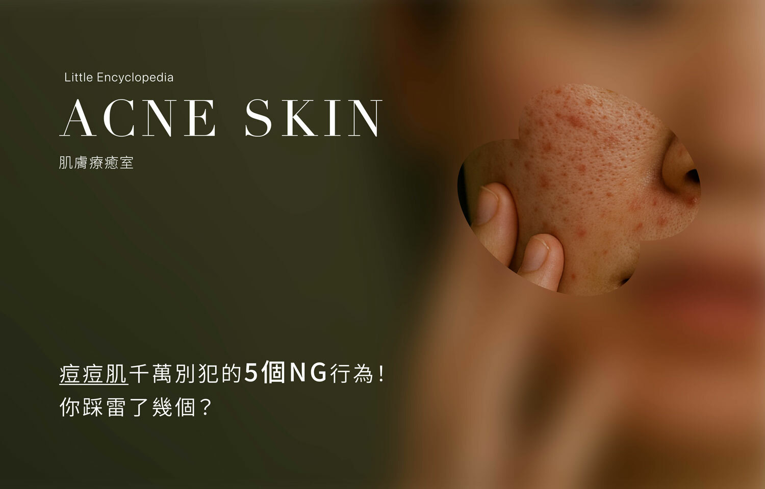 痘痘肌千萬別犯的5個NG行為！你踩雷了幾個？