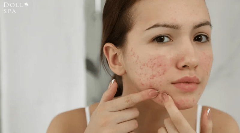 長時間戴口罩皮膚出油、長粉刺｜逗DOLLSPA