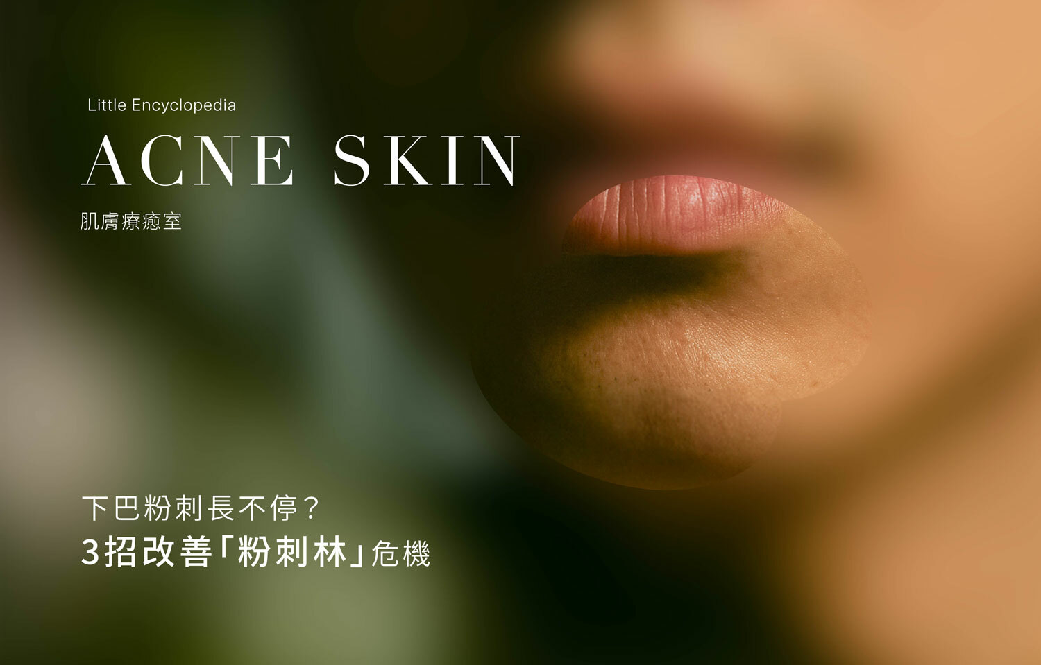 下巴粉刺長不停？3招改善「粉刺林」危機