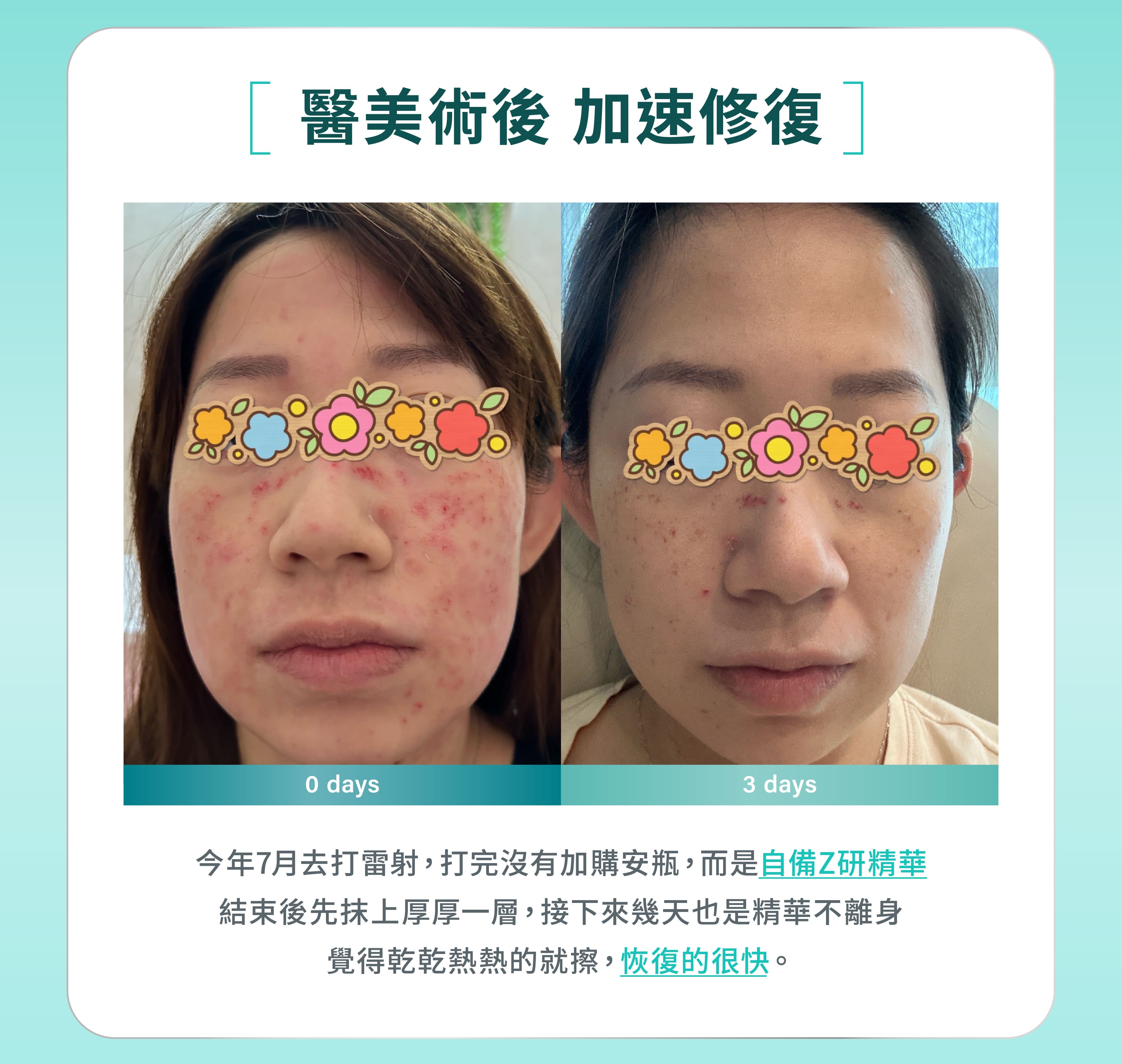 Z研精華液醫美術後修復實例,雷射後3天加速恢復