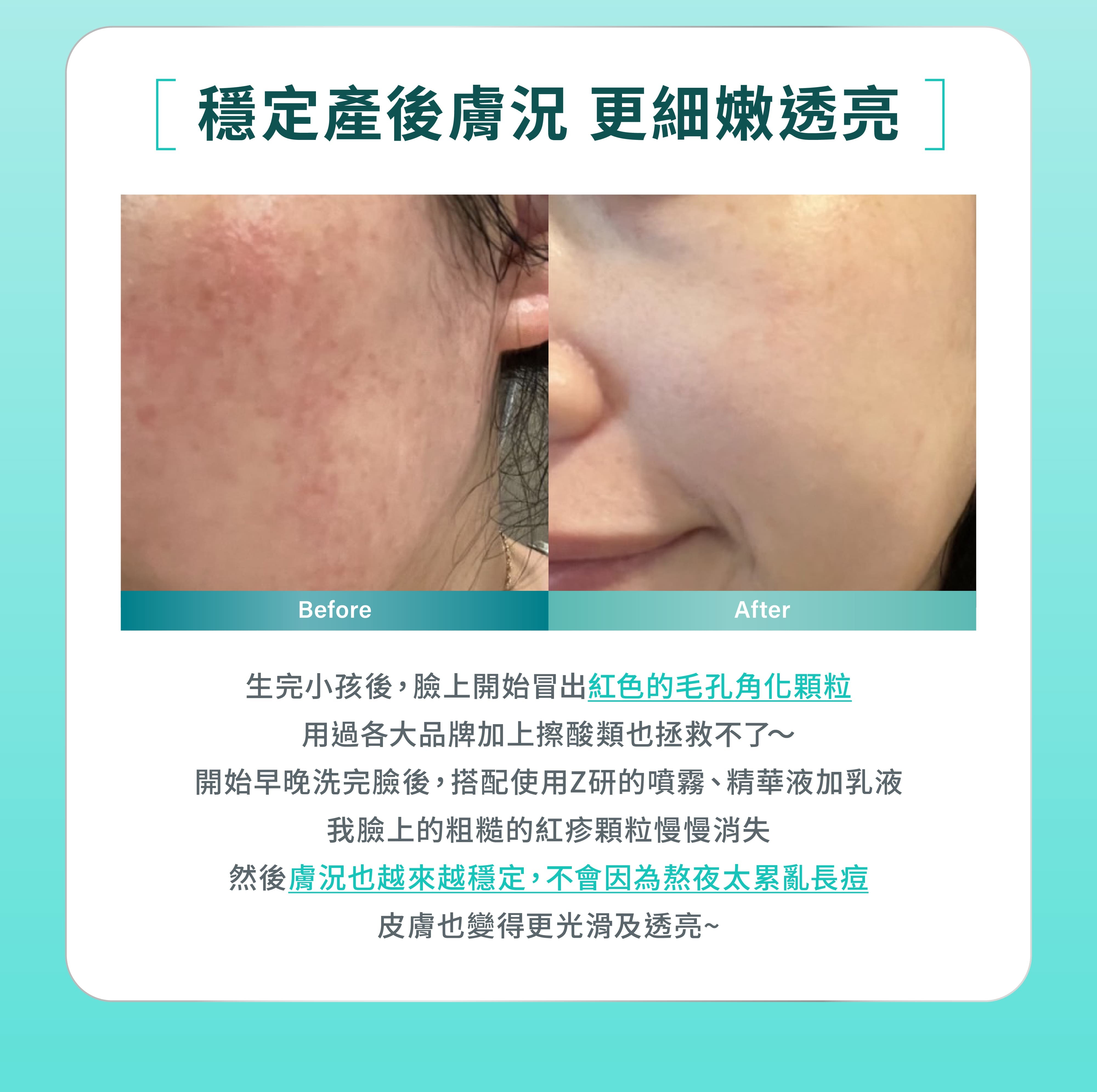 Z研產後肌膚修護實測:改善毛孔角化、紅疹顆粒,恢復光滑透亮膚質
