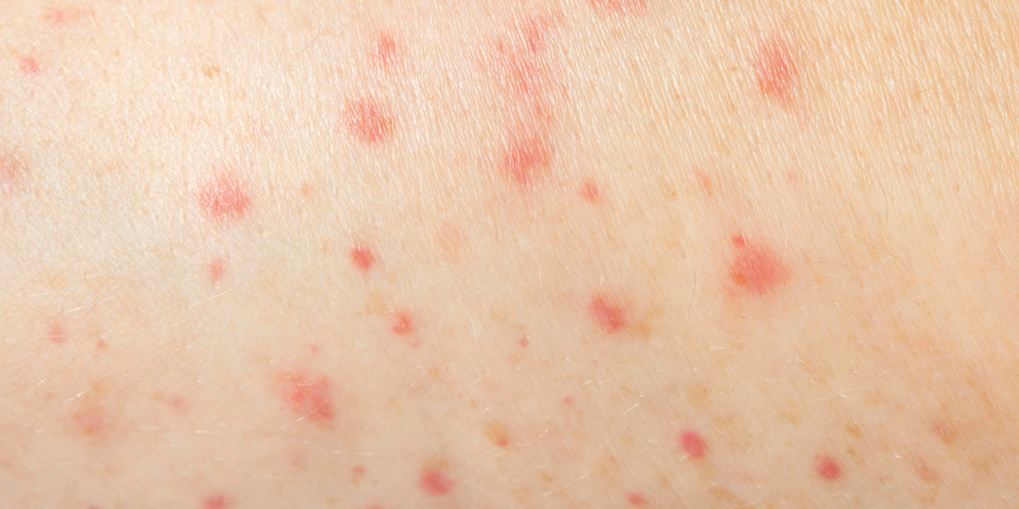 除毛若操作不當，容易導致毛囊炎。毛囊炎分為許多種類，其中常見的是細菌感染造成的毛囊炎