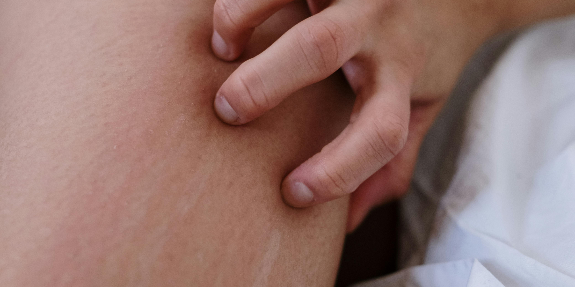 私密處除毛後很癢怎麼辦？1重點幫助你大幅緩解除毛後的不適感