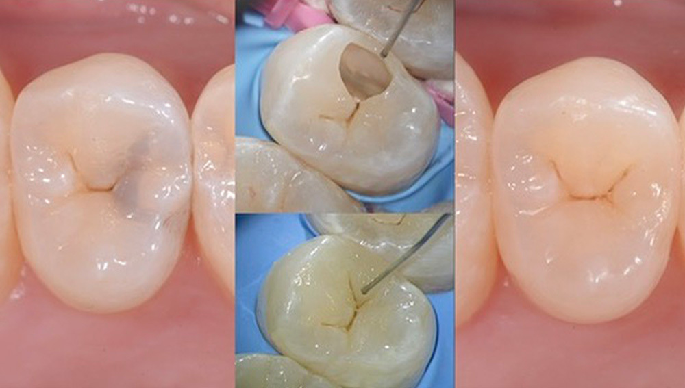 顯微流動樹酯注射頭 27G