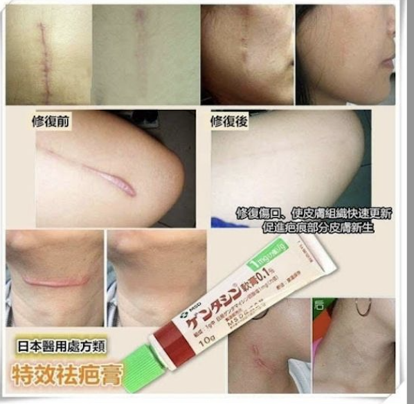 現 貨 日 本 直 送丨🇯🇵日本 MSD去疤膏10G 💯日本最好的祛疤凝胶