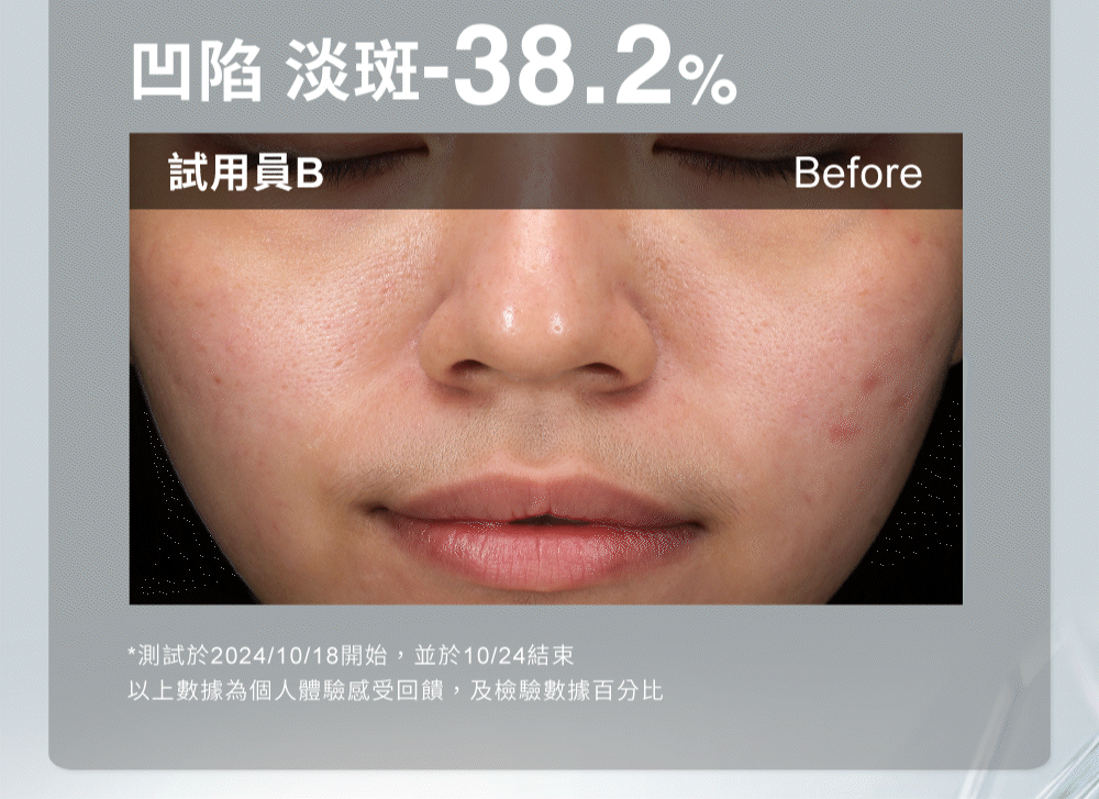 凹陷、淡斑-38.2%