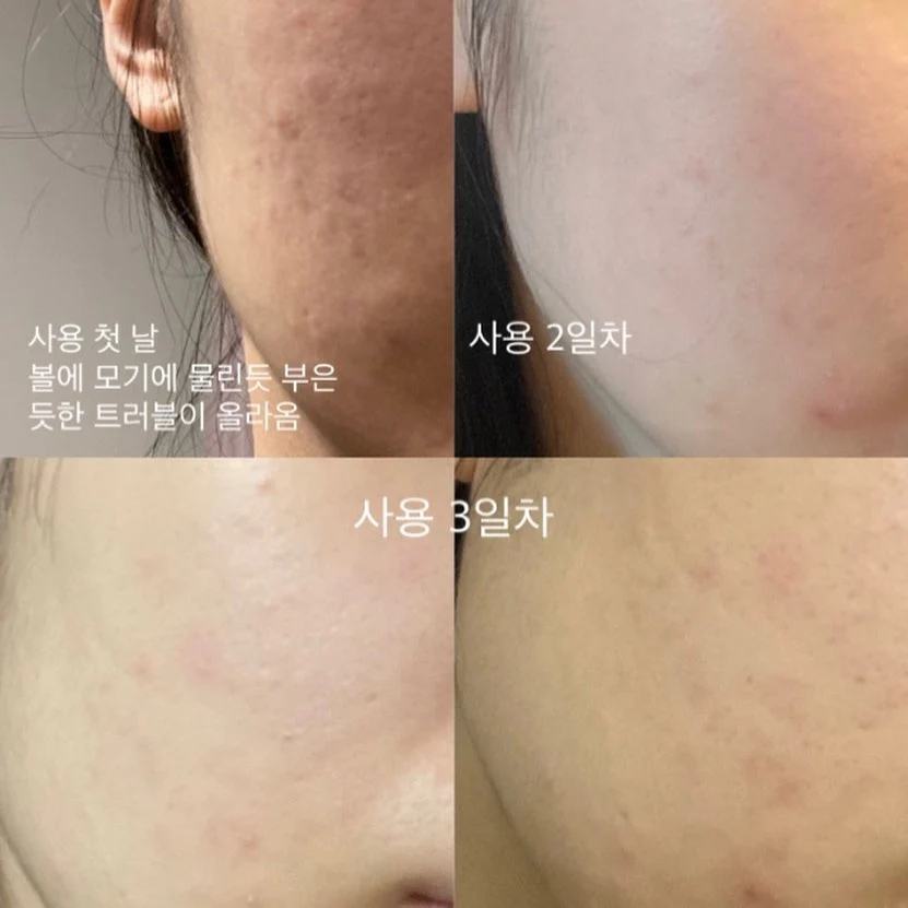 現 貨丨Anua 77 魚腥草去暗粒舒緩痘痘調理爽膚水丨250mL丨大支裝 500mL