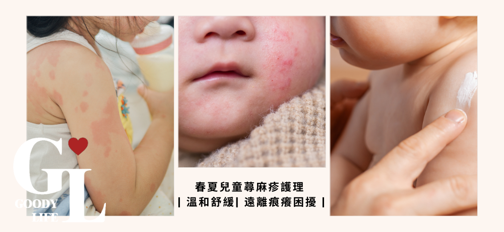 春夏兒童蕁麻疹護理