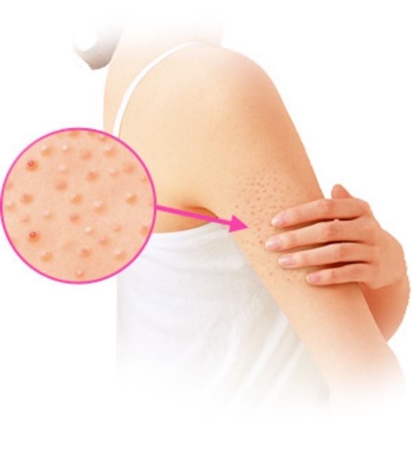 小林製藥 臂粒消無瑕膏