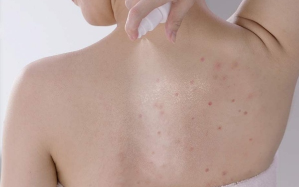 小林製藥 麗治背粒消無瑕噴劑