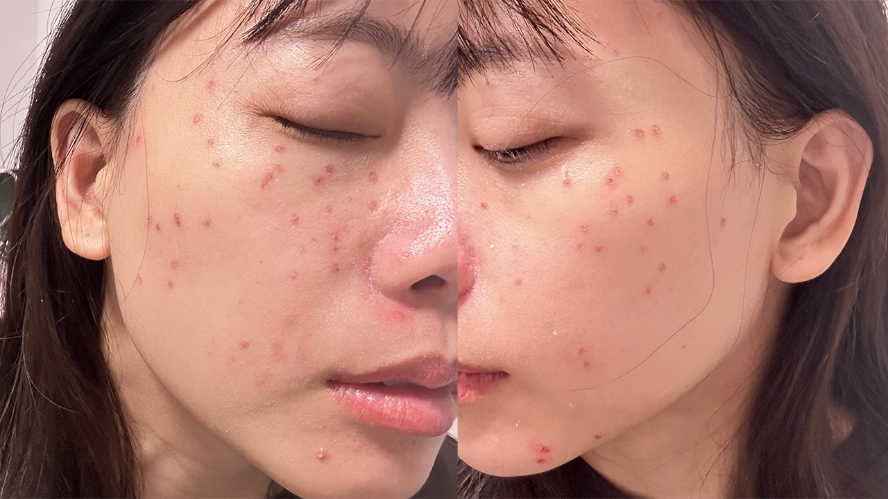 因為是用磨皮的方式把斑打掉，所以會在皮膚表面創造很多小傷口