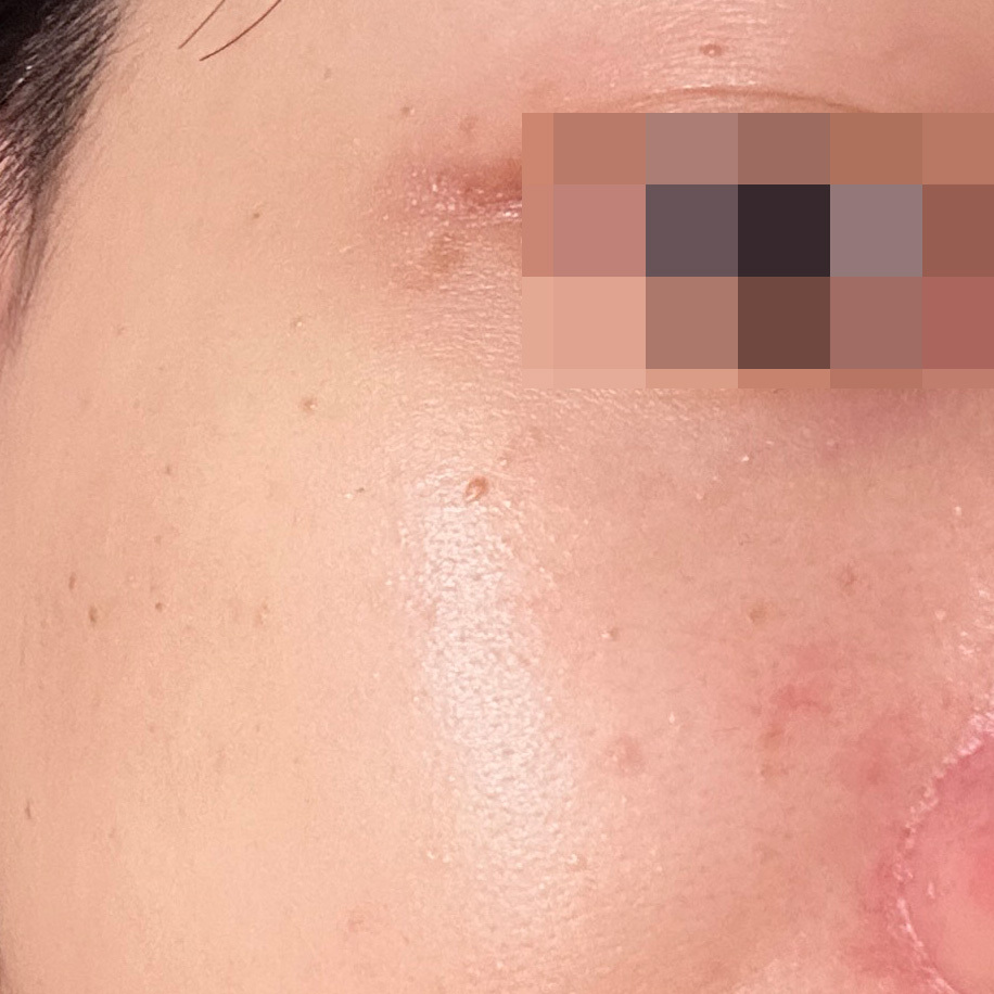 經過醫師判斷之後說是「黑色丘疹皮膚病」，成因主要是曬後老化，算是一種「斑」。